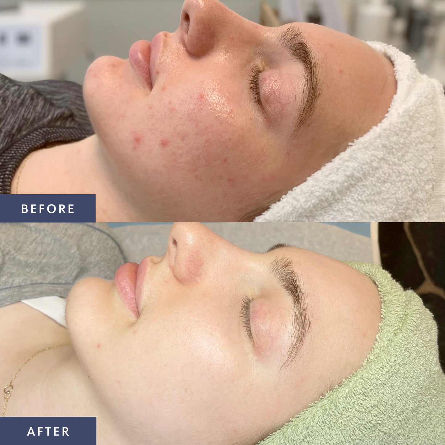 Mikura Clear Skin Program